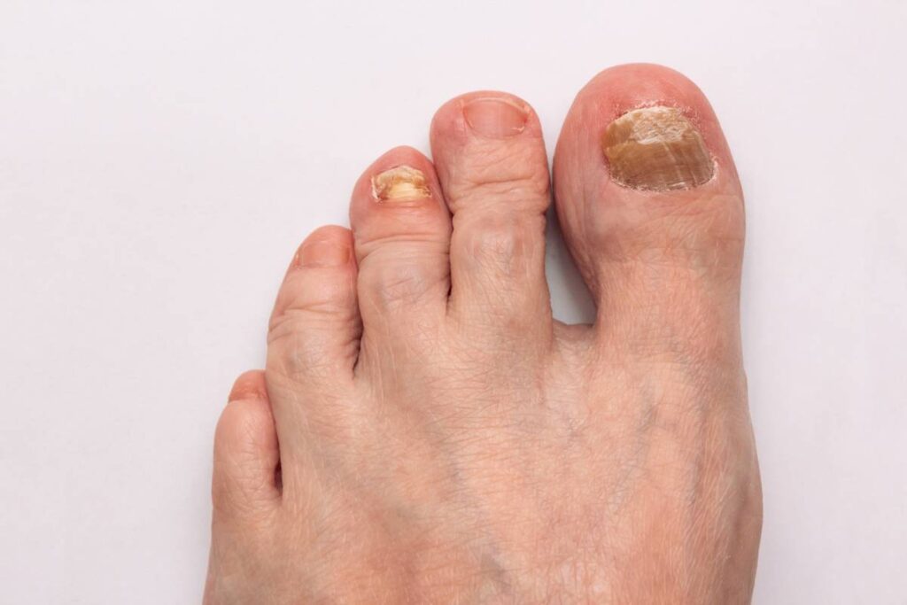 Nail Fungus (Onychomycosis)