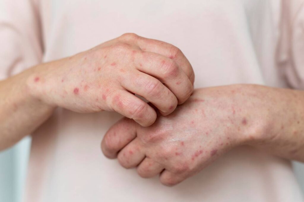 Ringworm