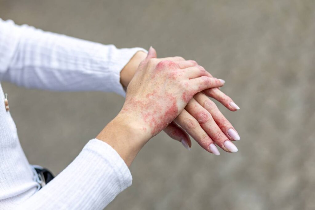 Scalp fungal infections
