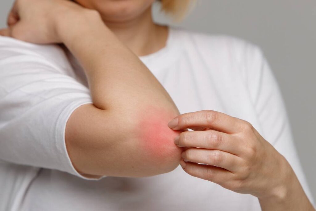 Rash spreading across the body