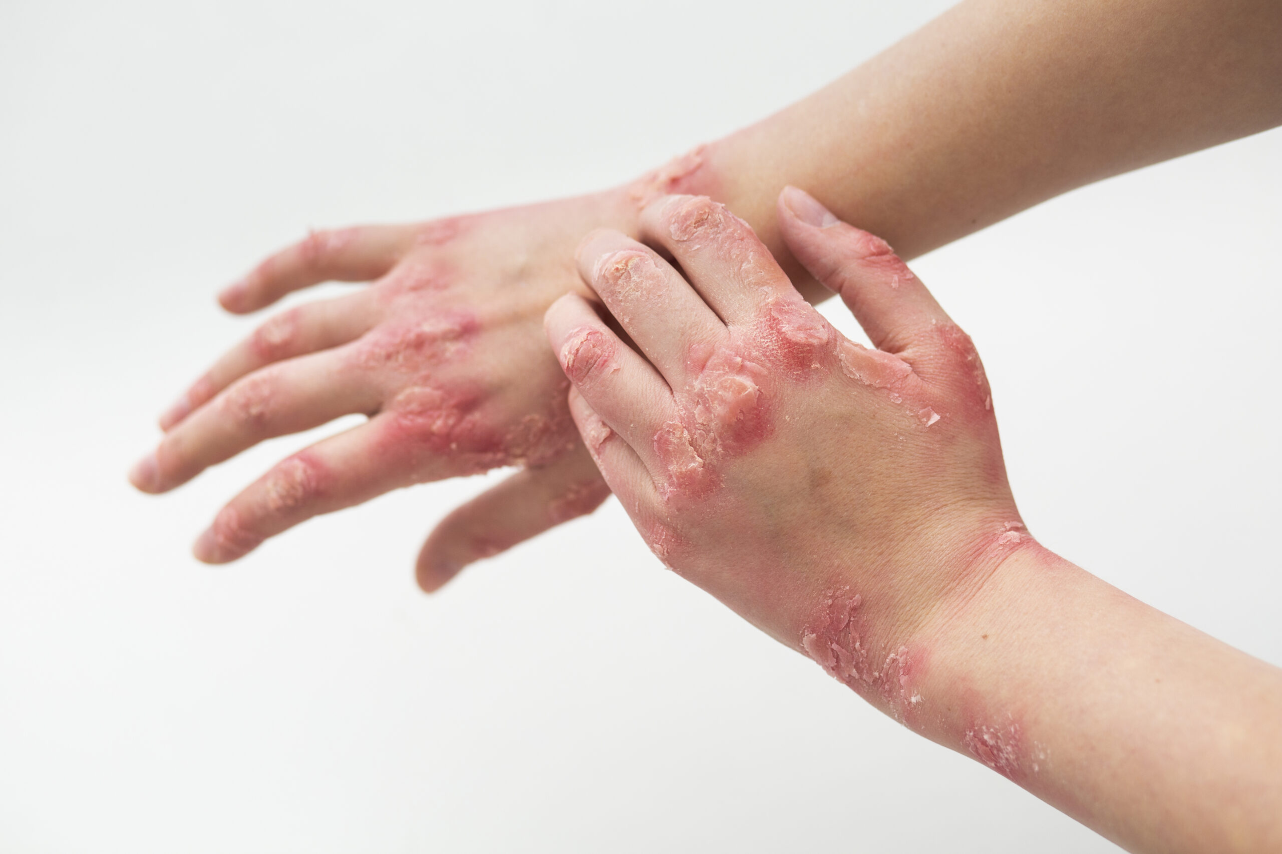 Fungal Infections